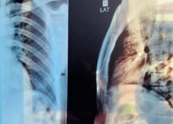 Korban Penganiayaan Melapor ke Polres Kampar