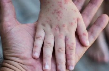 Virus Cacar Monyet Semakin Merebak, Diskes Pekanbaru Imbau Masyarakat Terapkan PHBS