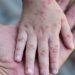 Virus Cacar Monyet Semakin Merebak, Diskes Pekanbaru Imbau Masyarakat Terapkan PHBS